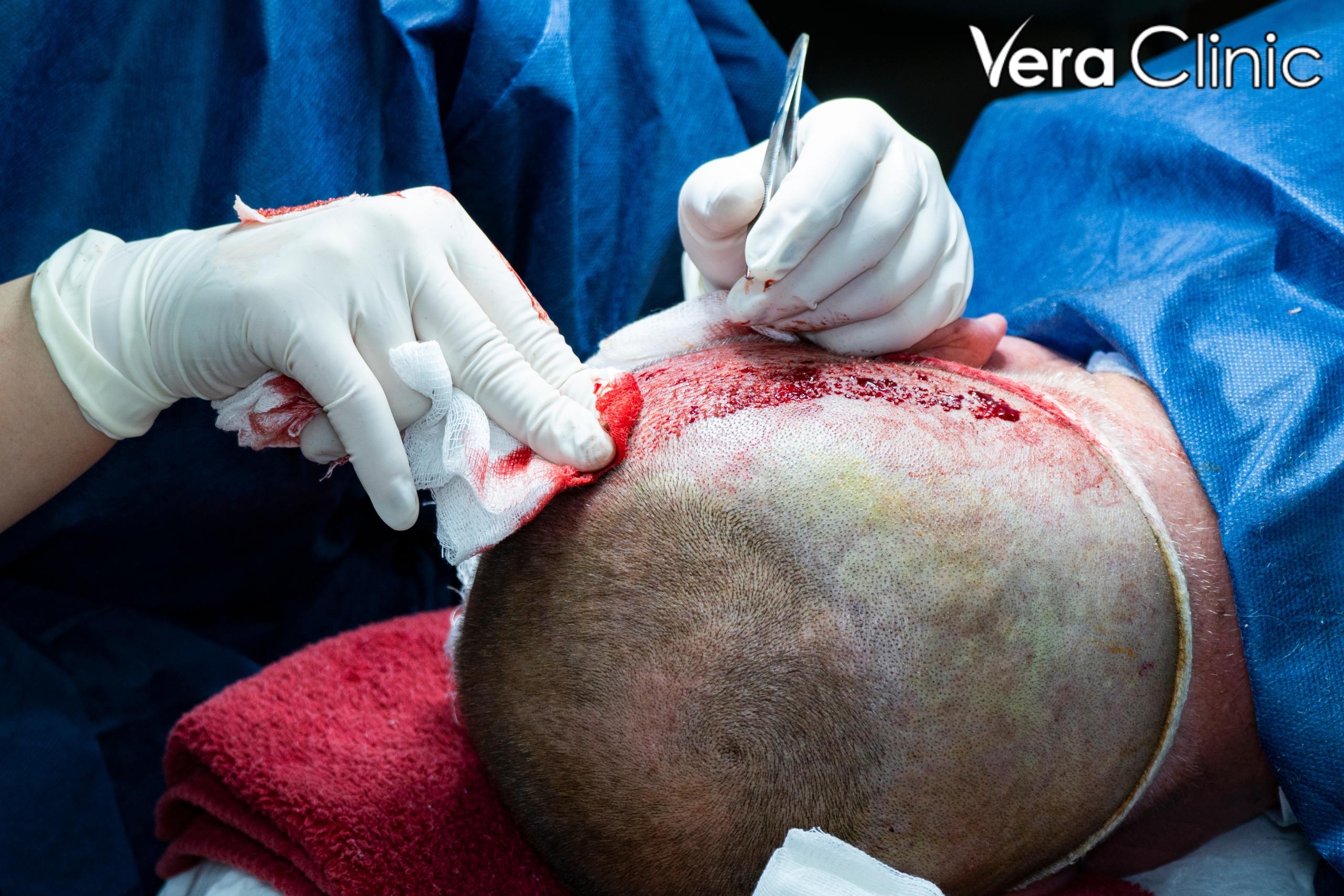 best hair transplant in turkey